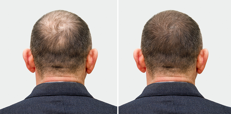 Hair loss Before and after photos