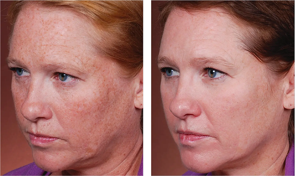 Skin Treatment Before and after photos